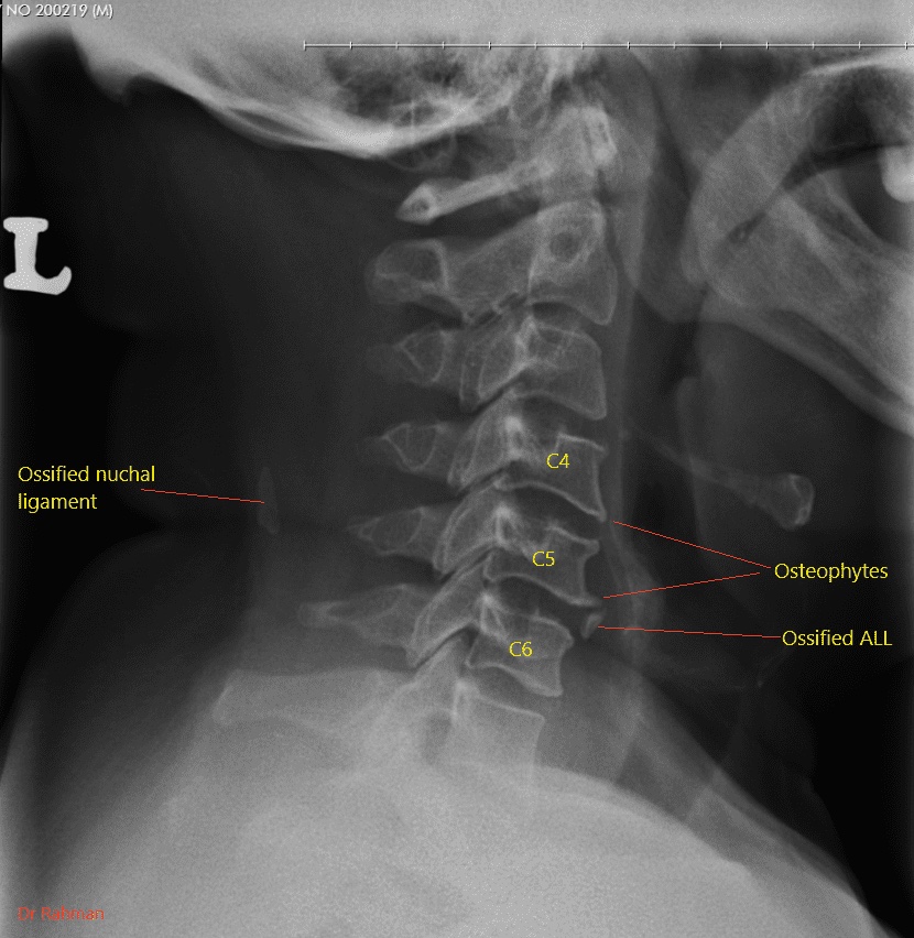 Radiografia cervical anotada com setas indicando osteófitos em C4, C5 e C6, ligamento nucal ossificado e ligamento longitudinal anterior ossificado.