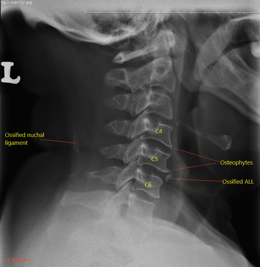 espondilose cervical foto