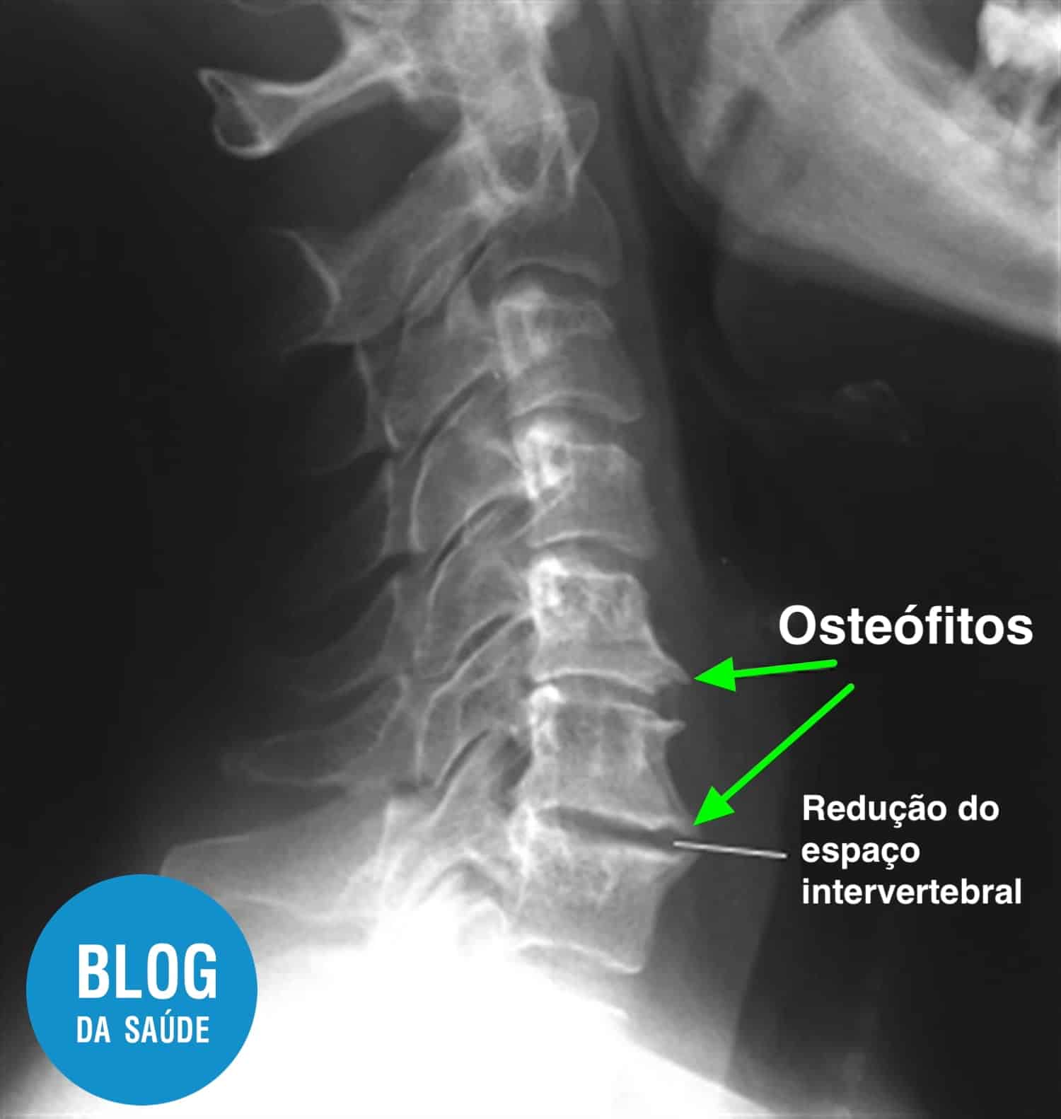 raio-x com osteofitos