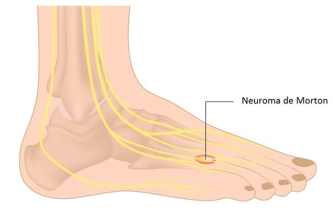 Diagrama do pe de perfil mostrando os nervos digitais em amarelo, com um ponto vermelho entre as cabeças dos metatarsos rotulado Neuroma de Morton
