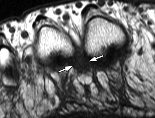 neuroma de morton ressonancia