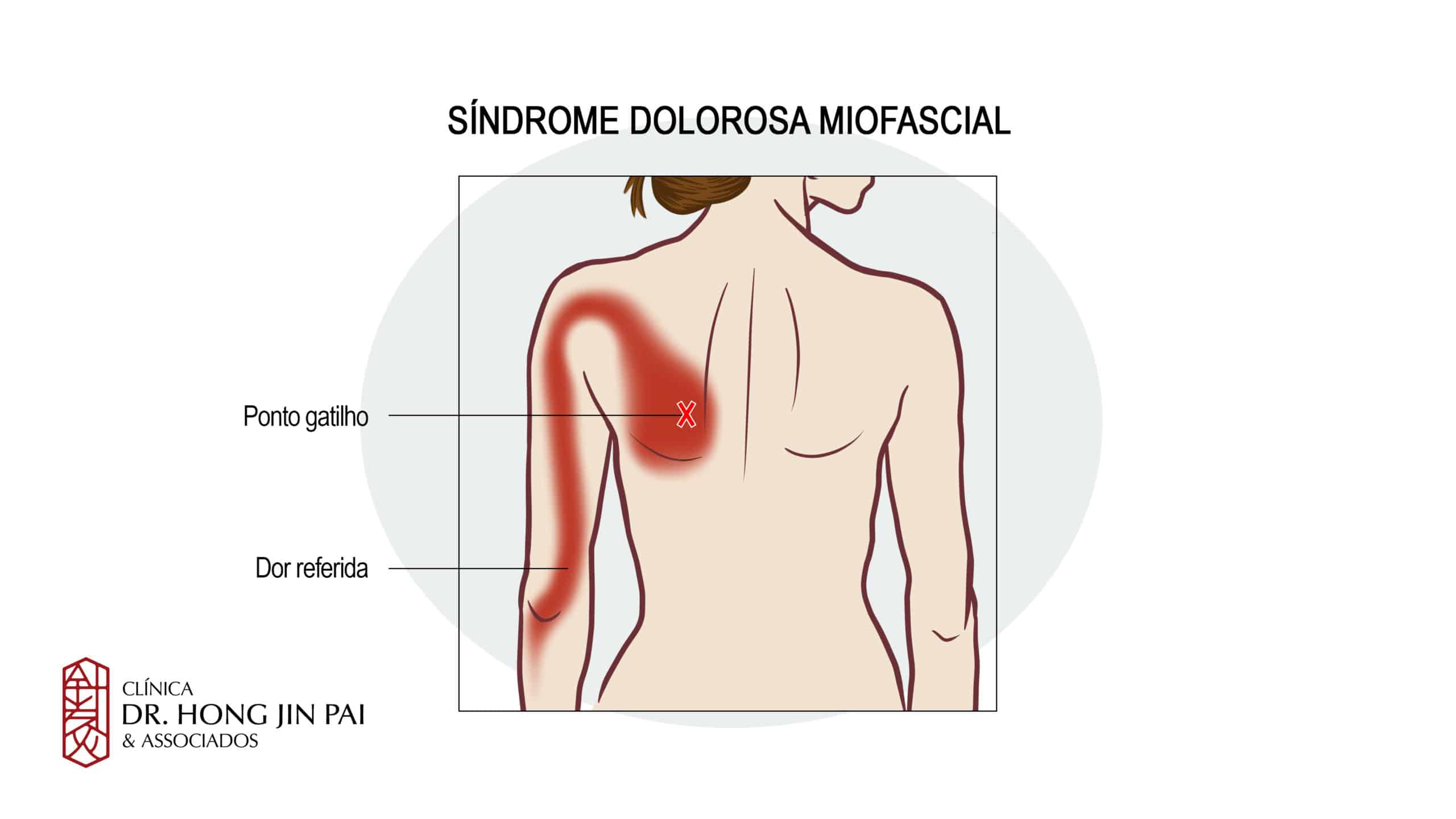 A dor miofascial pode dar dor irradiada para os braços
