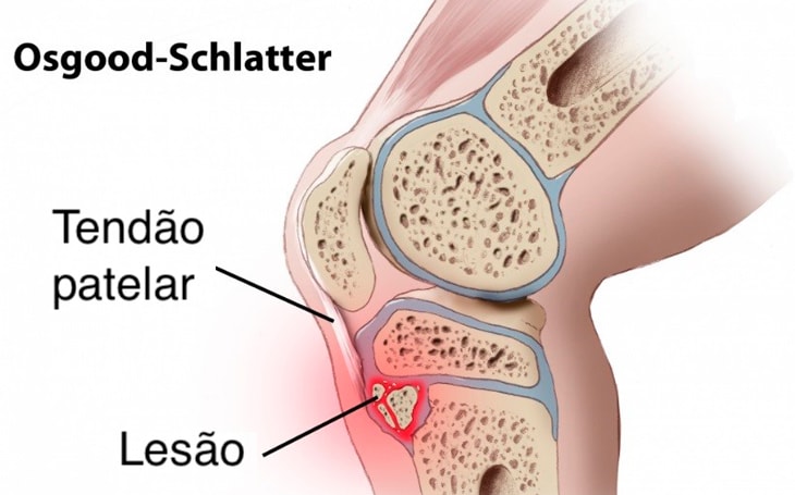 Doença-de-Osgood-Schlatter