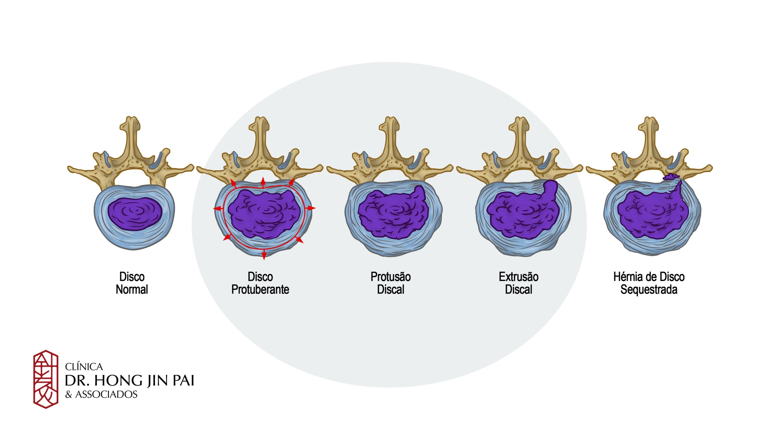 Alterações no Disco: Hérnia, protusão, desgaste, degeneração