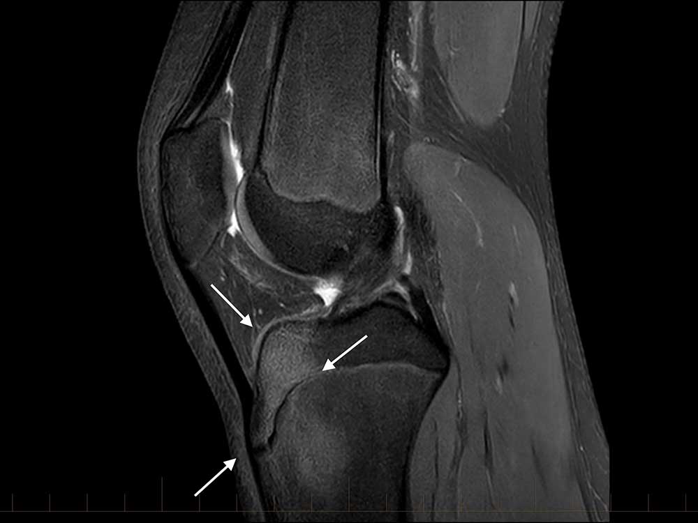 Osgood Schlatter ressonancia