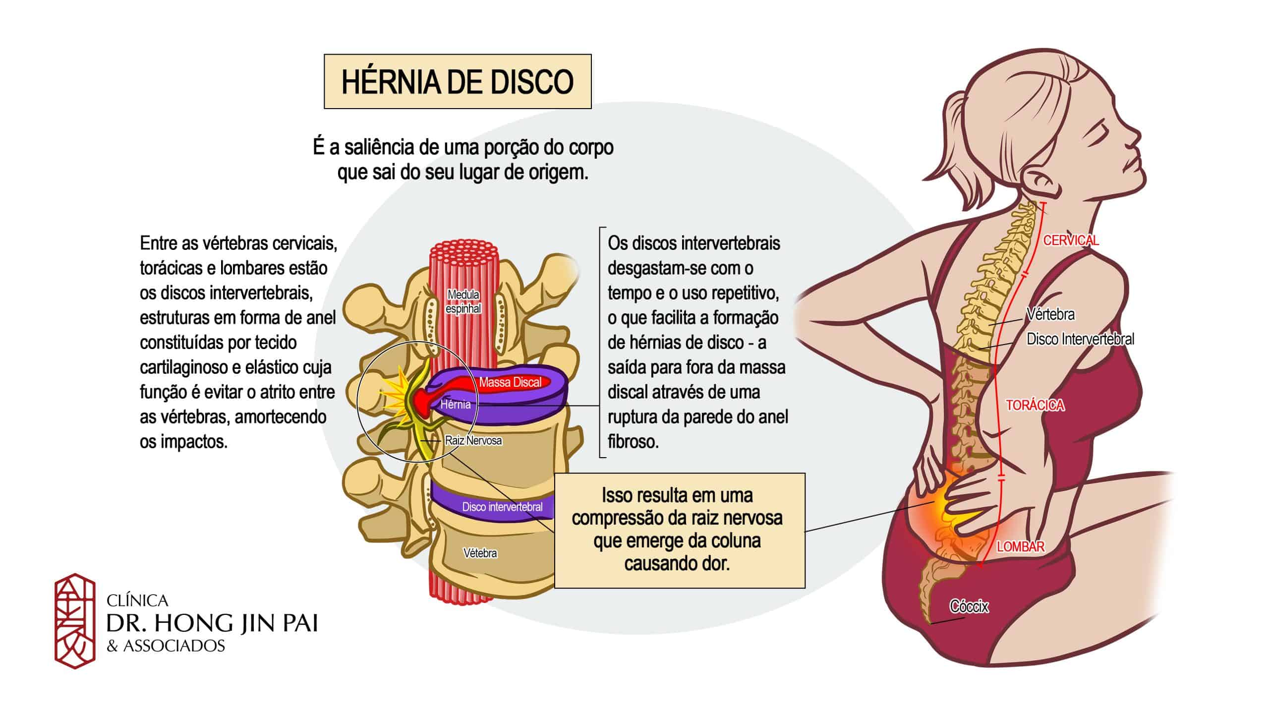 Hernia de Disco