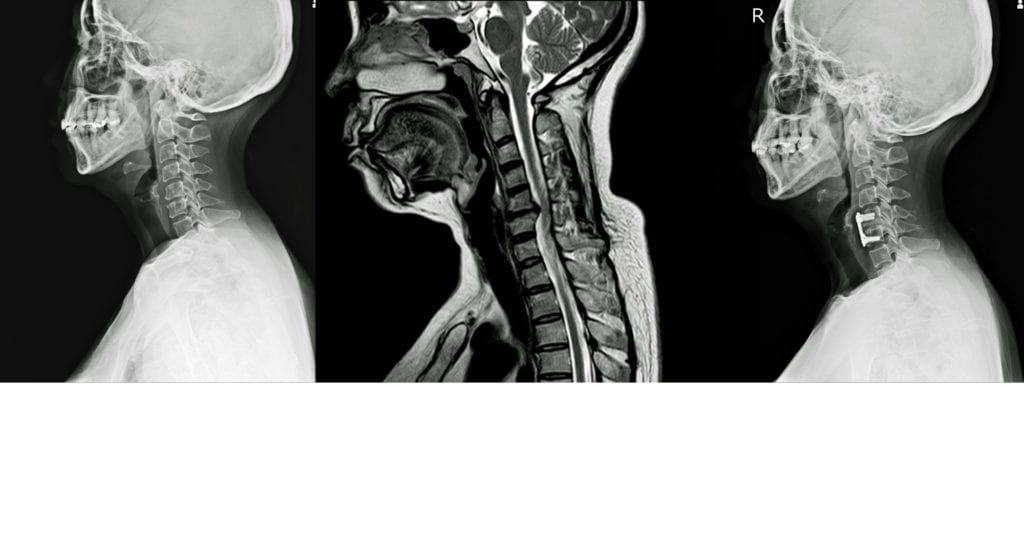 Painel com radiografia lateral do pescoço, ressonância sagital da coluna cervical e radiografia pós-operatória com placa fixadora nas vértebras.
