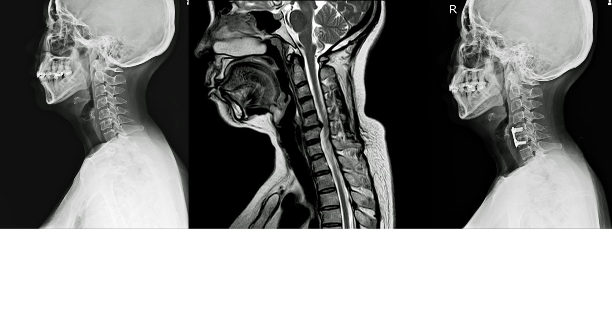 Raio-X e ressonancia de cervical para avaliacao de dor