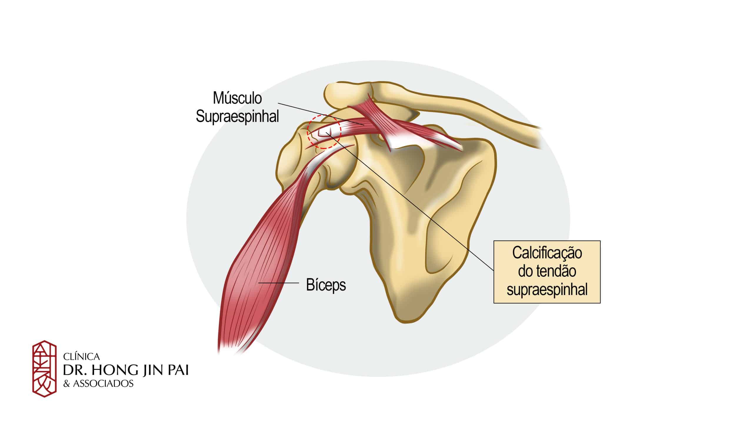 Calcificacao Tendinite Calcaria Ombro