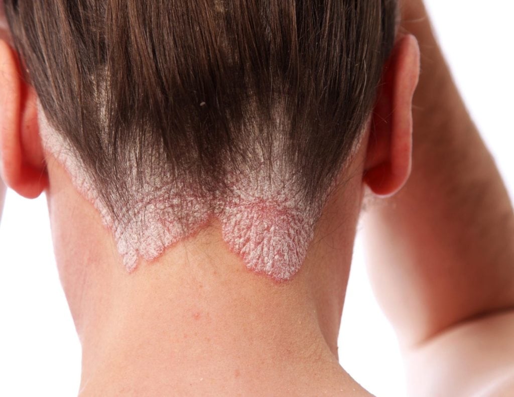 Nuca e couro cabeludo na linha do cabelo com psoríase: placas avermelhadas recobertas por escamas espessas e esbranquiçadas junto à raiz dos cabelos