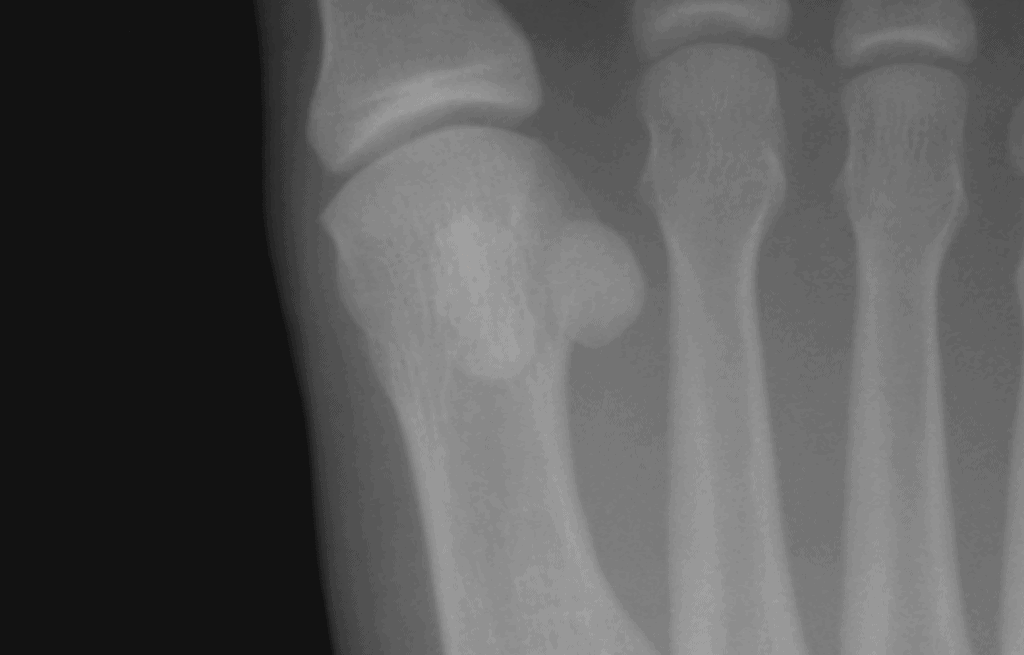 Radiografia do antepé mostrando os dois pequenos ossos sesamoides arredondados sob a cabeça do primeiro metatarso, na base do hálux.