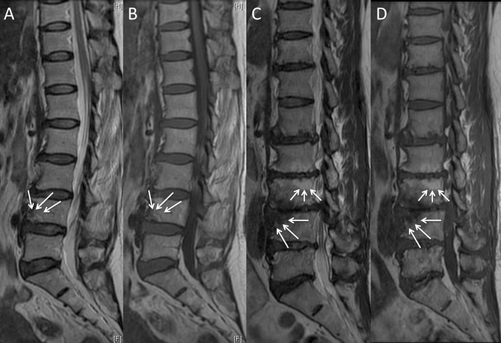 Quatro ressonâncias magneticas sagitais da coluna lombar lado a lado, marcadas A, B, C e D, com setas brancas apontando para alterações de sinal nas placas terminais e nos corpos vertebrais adjacentes ao disco.