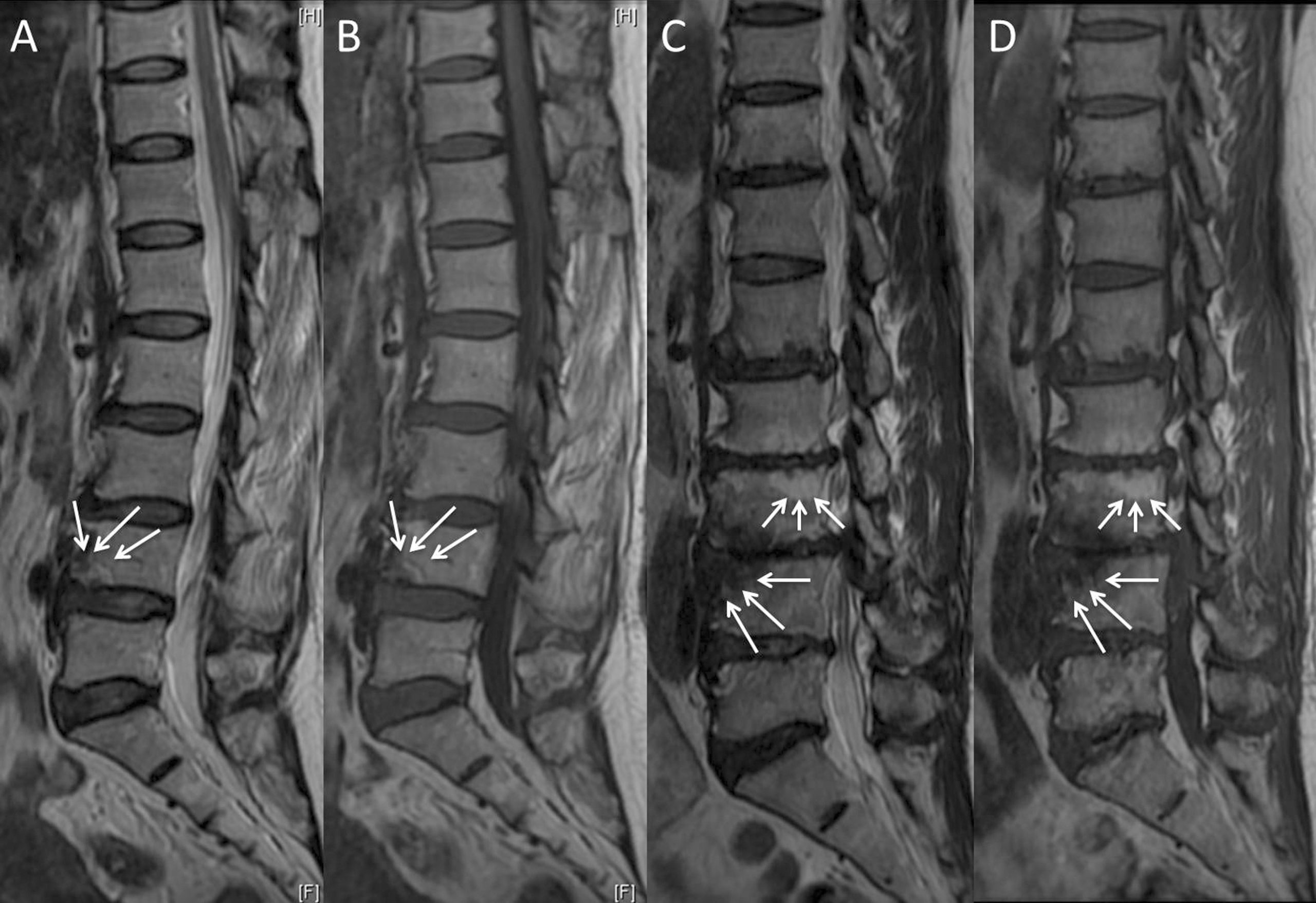 Lesão do platô vertebral: a área é bastante inervada, sendo que as alterações mais agudas, de edema ósseo (chamado de MODIC I), podem ser fonte de dor.