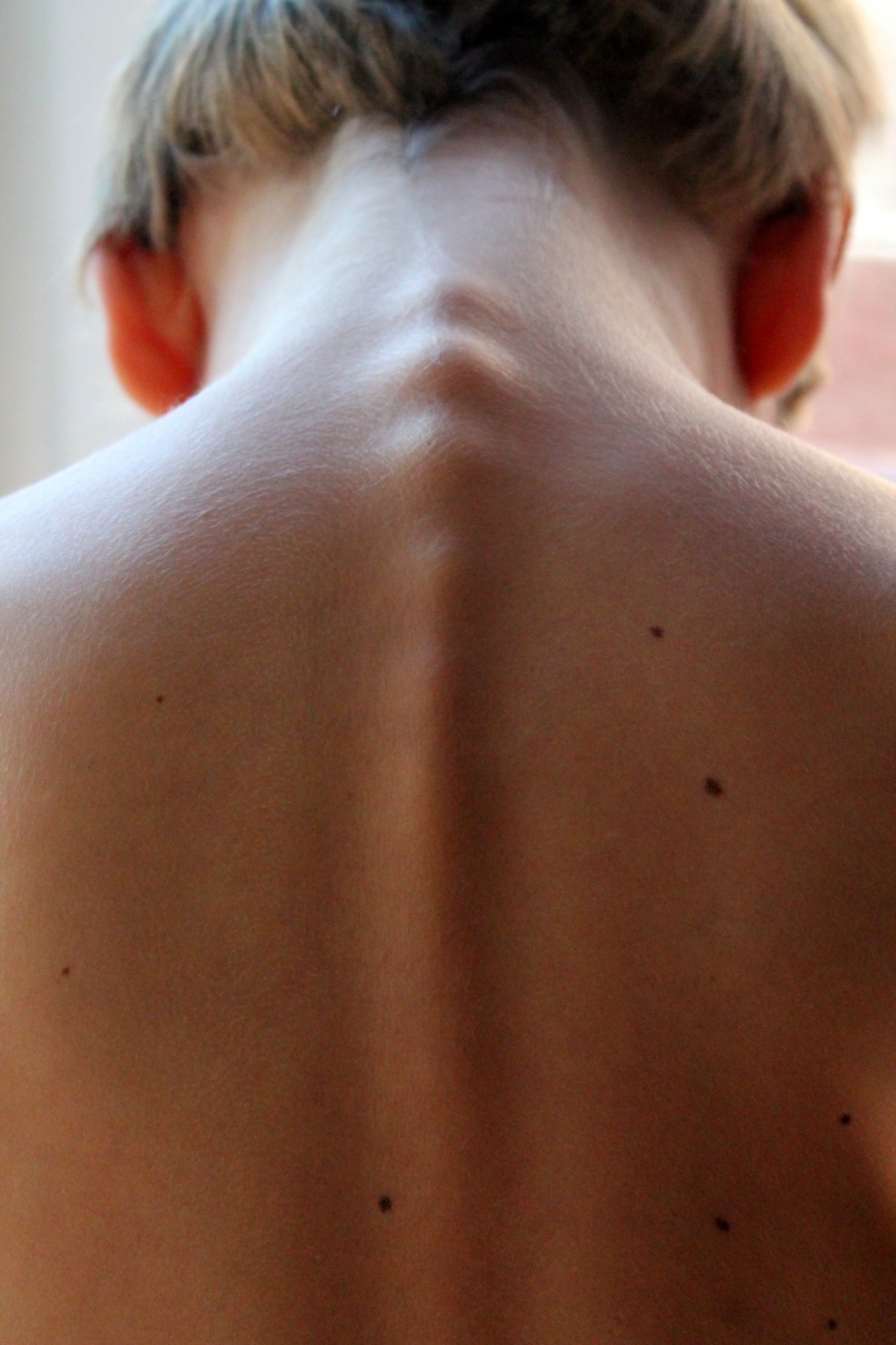 Radiofrequência para dor crônica: coluna e articulações 1 Render 3D de um corpo humano de perfil com a coluna vertebral iluminada em laranja, do pescoço até o sacro.