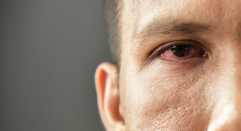Close de um olho humano com a esclera intensamente avermelhada e irritada, vasos sanguíneos visíveis na superfície ocular.