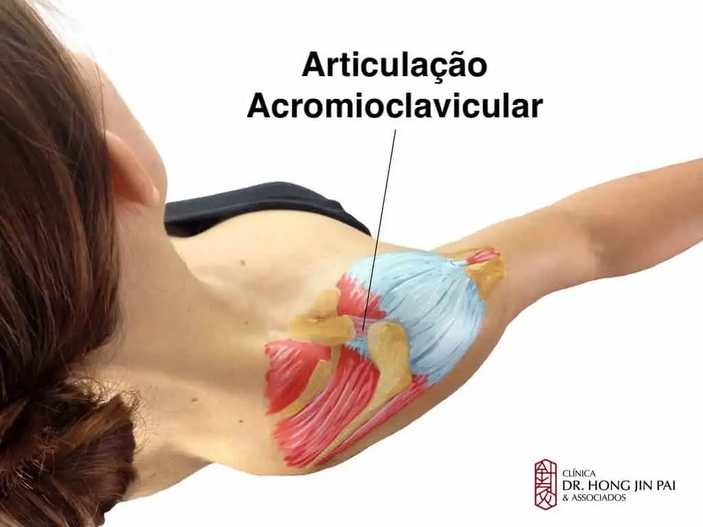 Articulacao Acromioclavicular - artrose no ombro