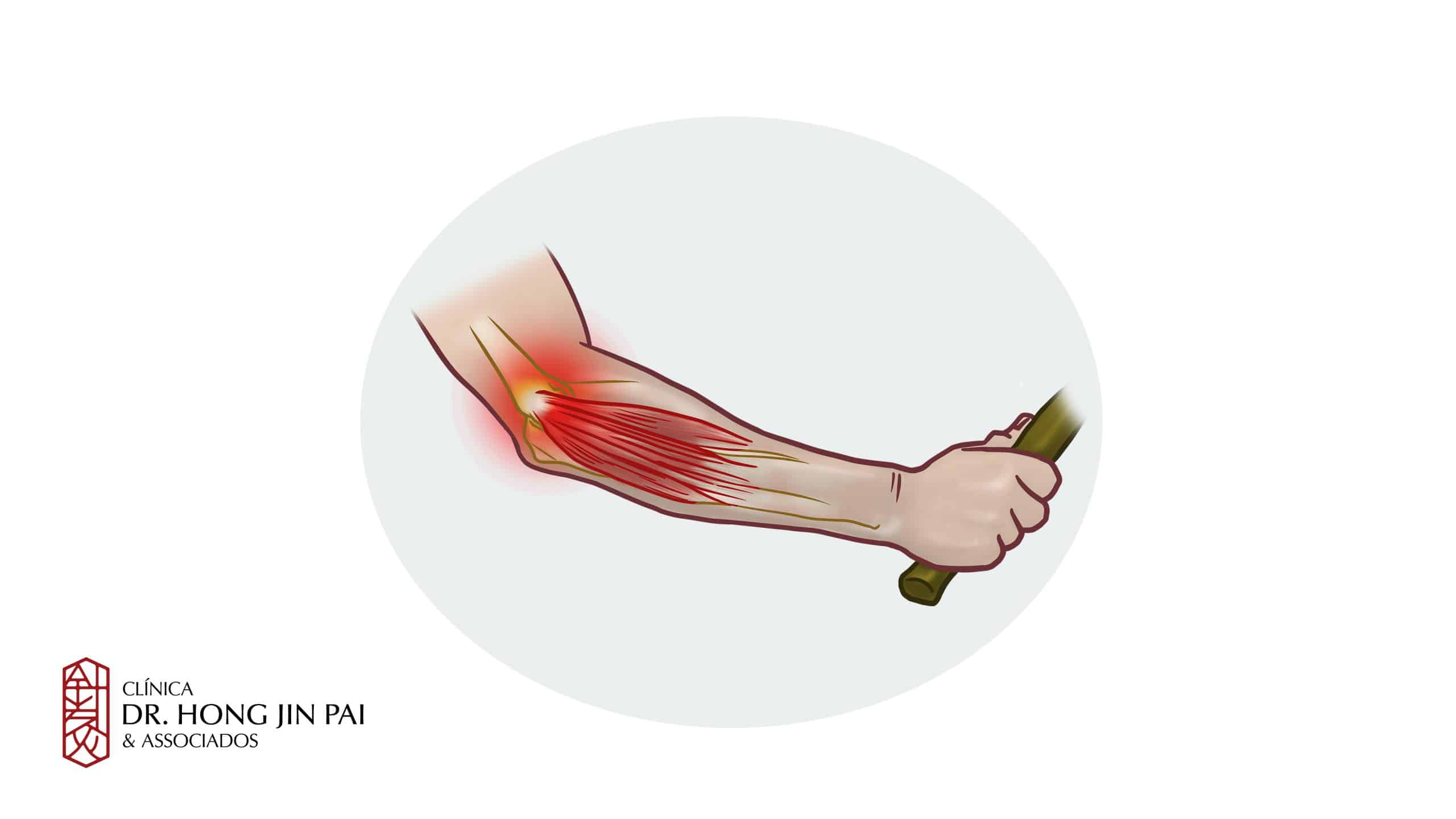 Dor no cotovelo epicondilite lateral