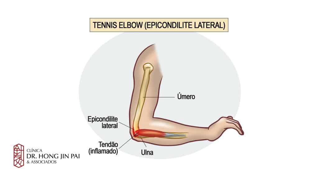 Ilustração do cotovelo em tennis elbow (epicondilite lateral): úmero, ulna e o tendão extensor inflamado destacado em vermelho no epicôndilo lateral