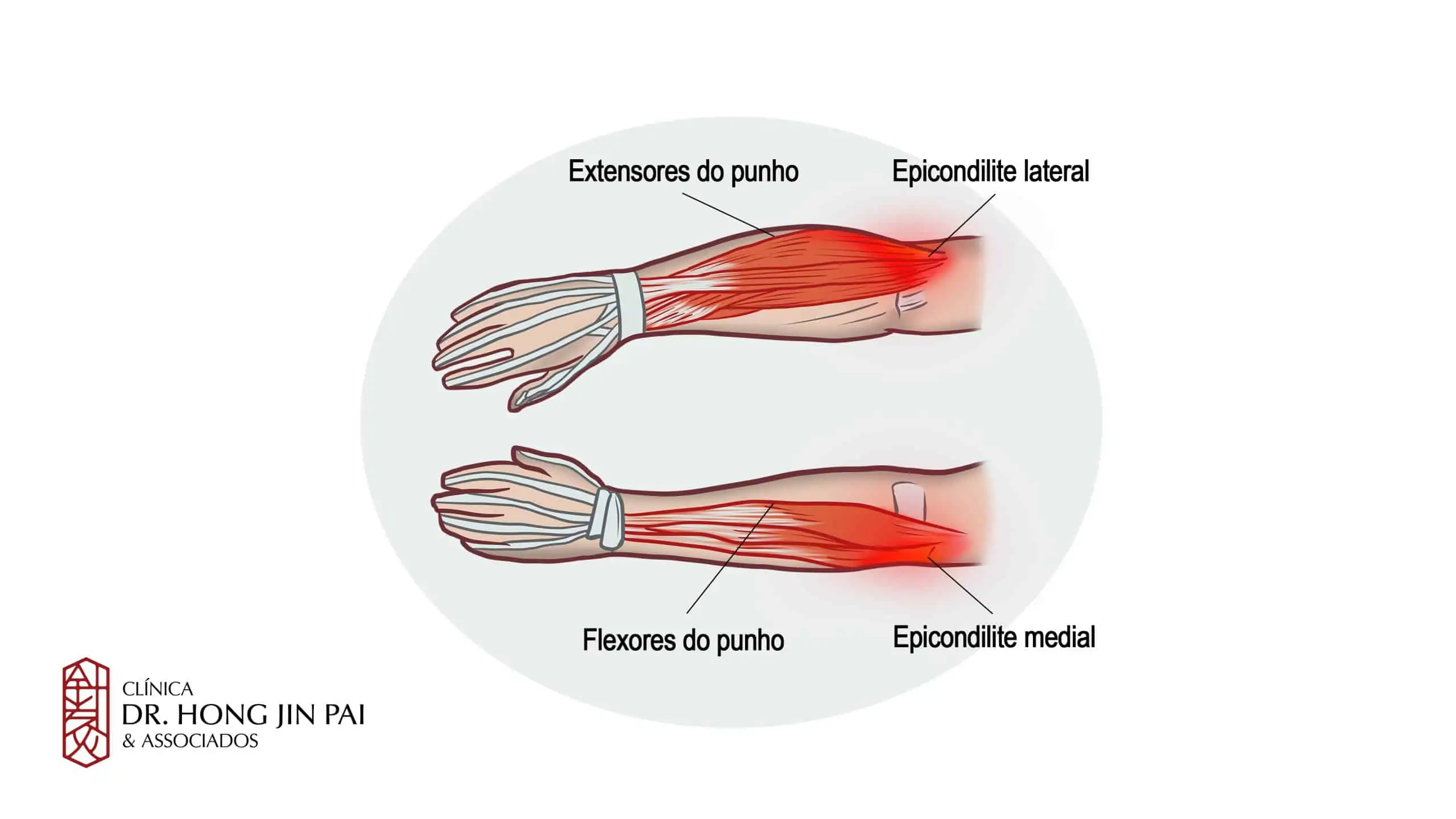 Epicondilite Lateral e Epicondilite Medial