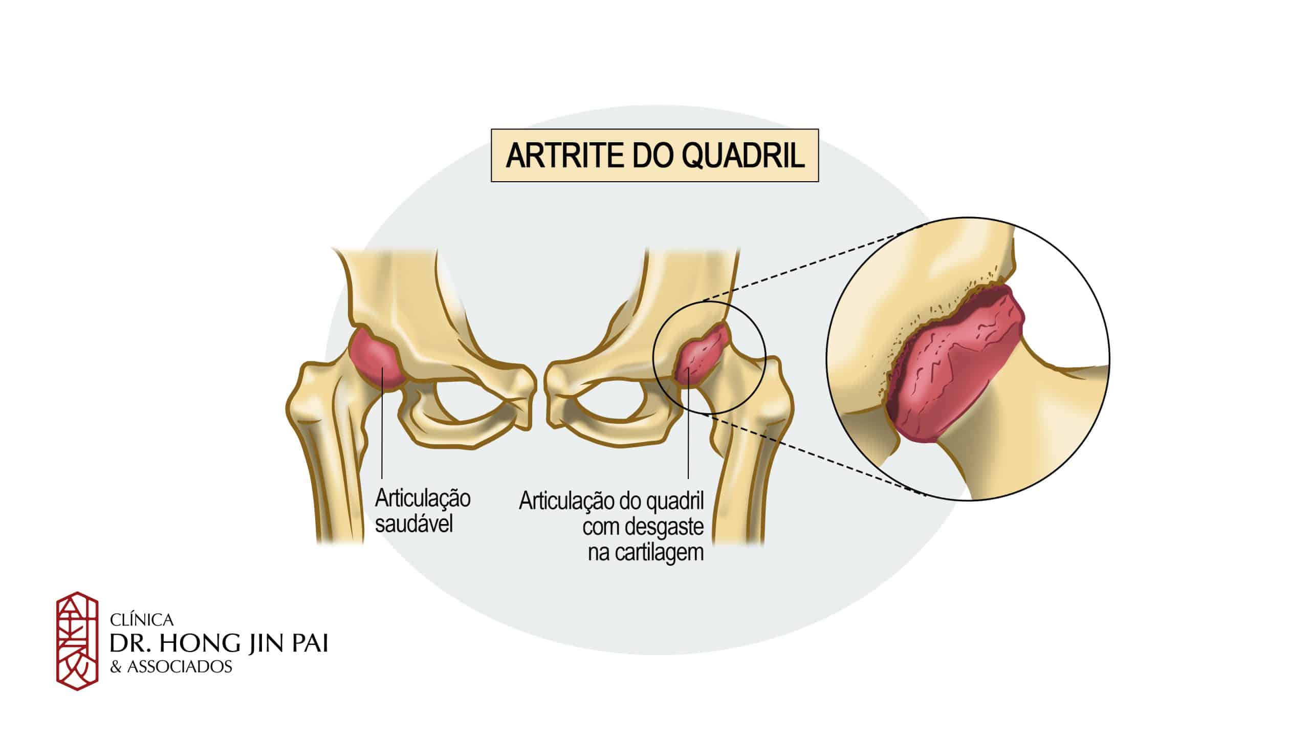 Artrite do Quadril