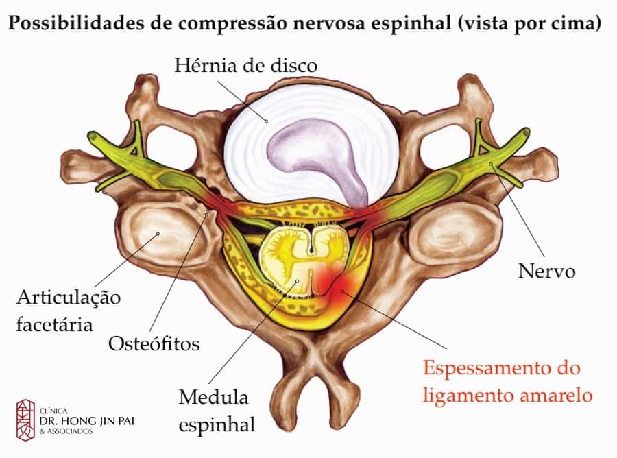 HIPERTROFIA LIGAMENTO AMARELO