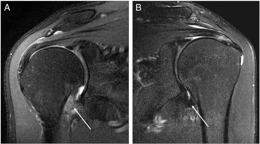 Duas imagens de ressonância magnética do ombro em corte coronal, com setas brancas apontando para o espessamento do recesso axilar da cápsula articular.