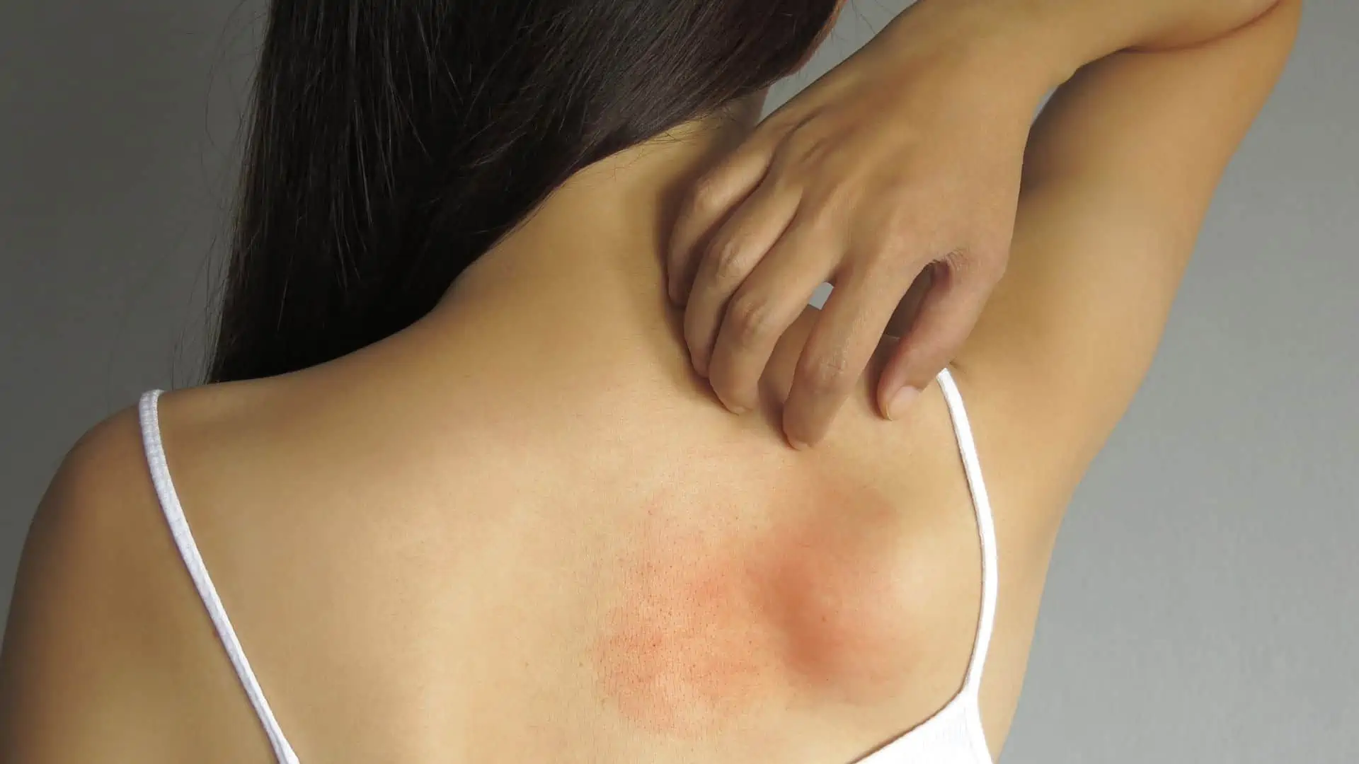 fibromialgia causa sintomas na pele