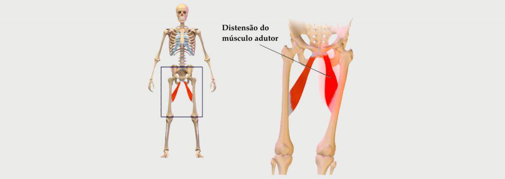 Distensão na virilha- Sintomas e tratamentos