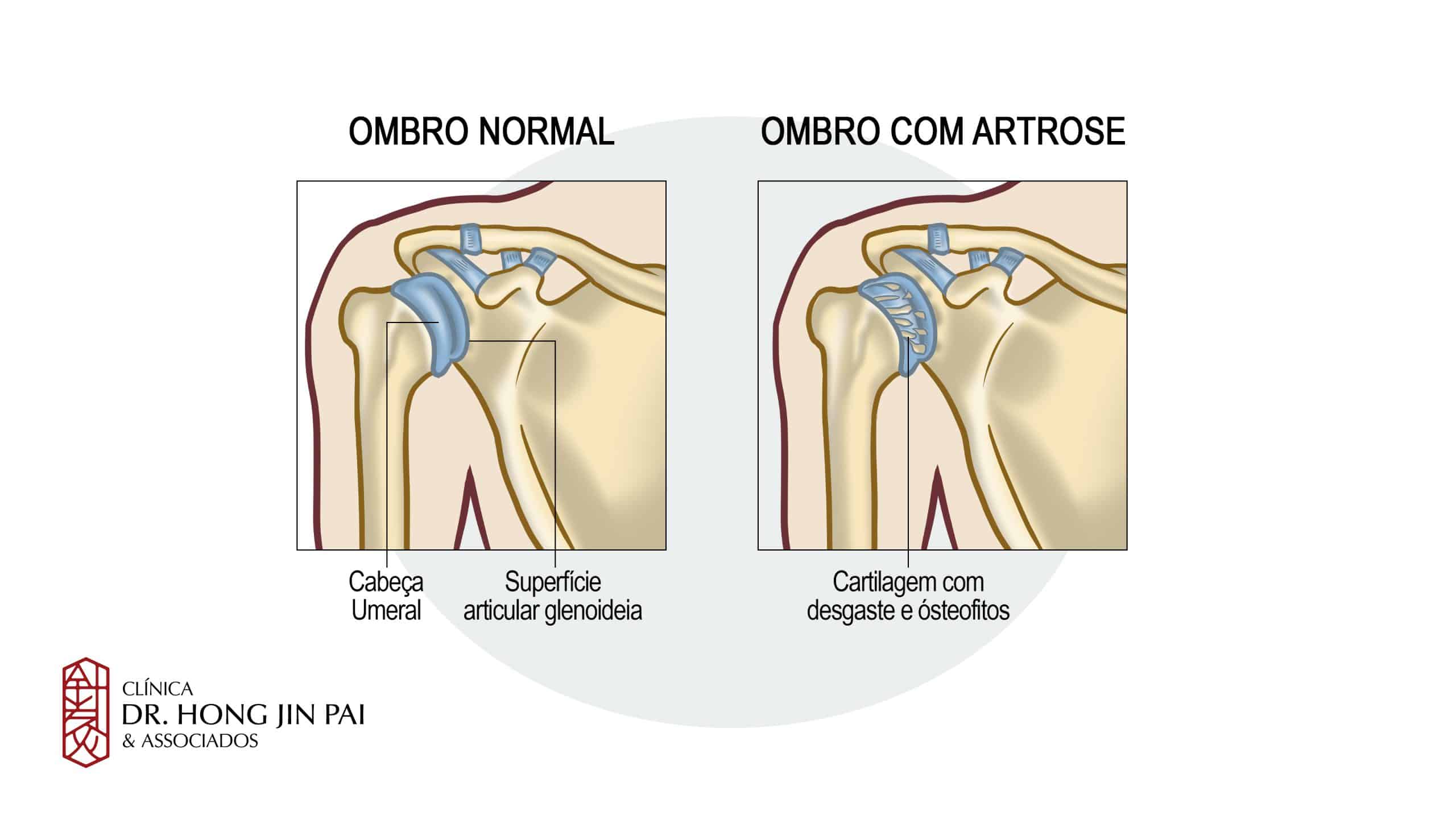 ombro com artrose scaled