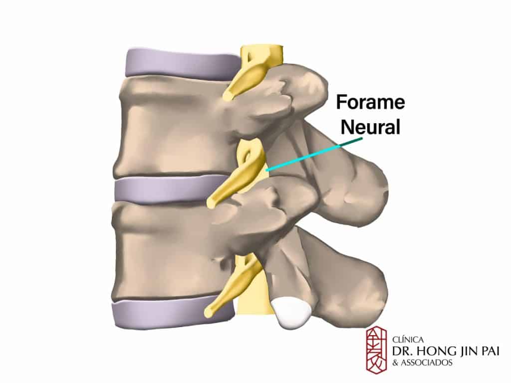 Vista lateral de três vértebras com discos roxos e raízes nervosas amarelas, com seta indicando o forame neural entre duas vértebras