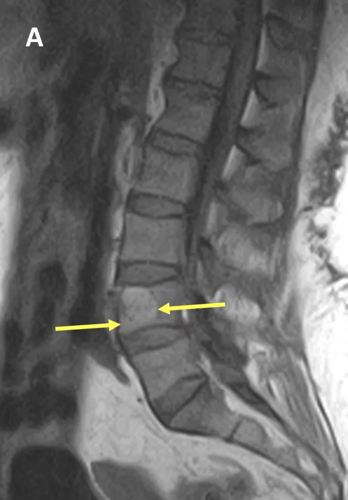 Ressonância magnética sagital da coluna lombar com duas setas amarelas apontando para um corpo vertebral alterado.