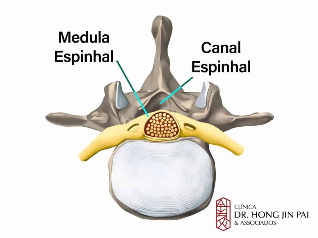 Corte transversal de uma vértebra mostrando a medula espinhal no centro e o canal espinhal ao redor, com nervos amarelos