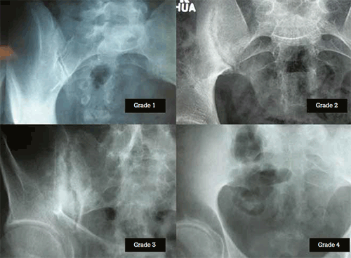 Painel de quatro radiografias da bacia mostrando as articulações sacroilíacas classificadas do Grau 1 ao Grau 4, com erosão e fusão progressivas.