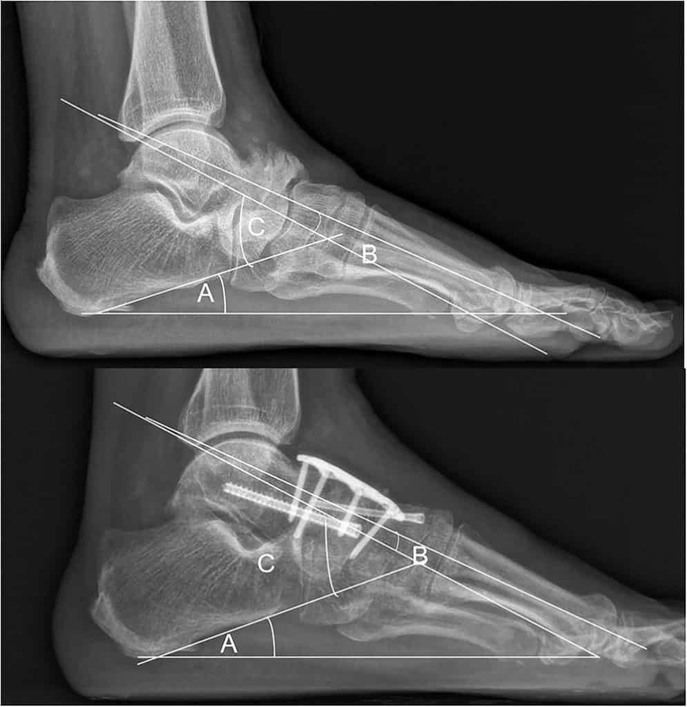 Radiografias de perfil do pé antes e depois de cirurgia, com linhas marcando os ângulos A, B e C do retropé e parafusos de fixação na imagem inferior