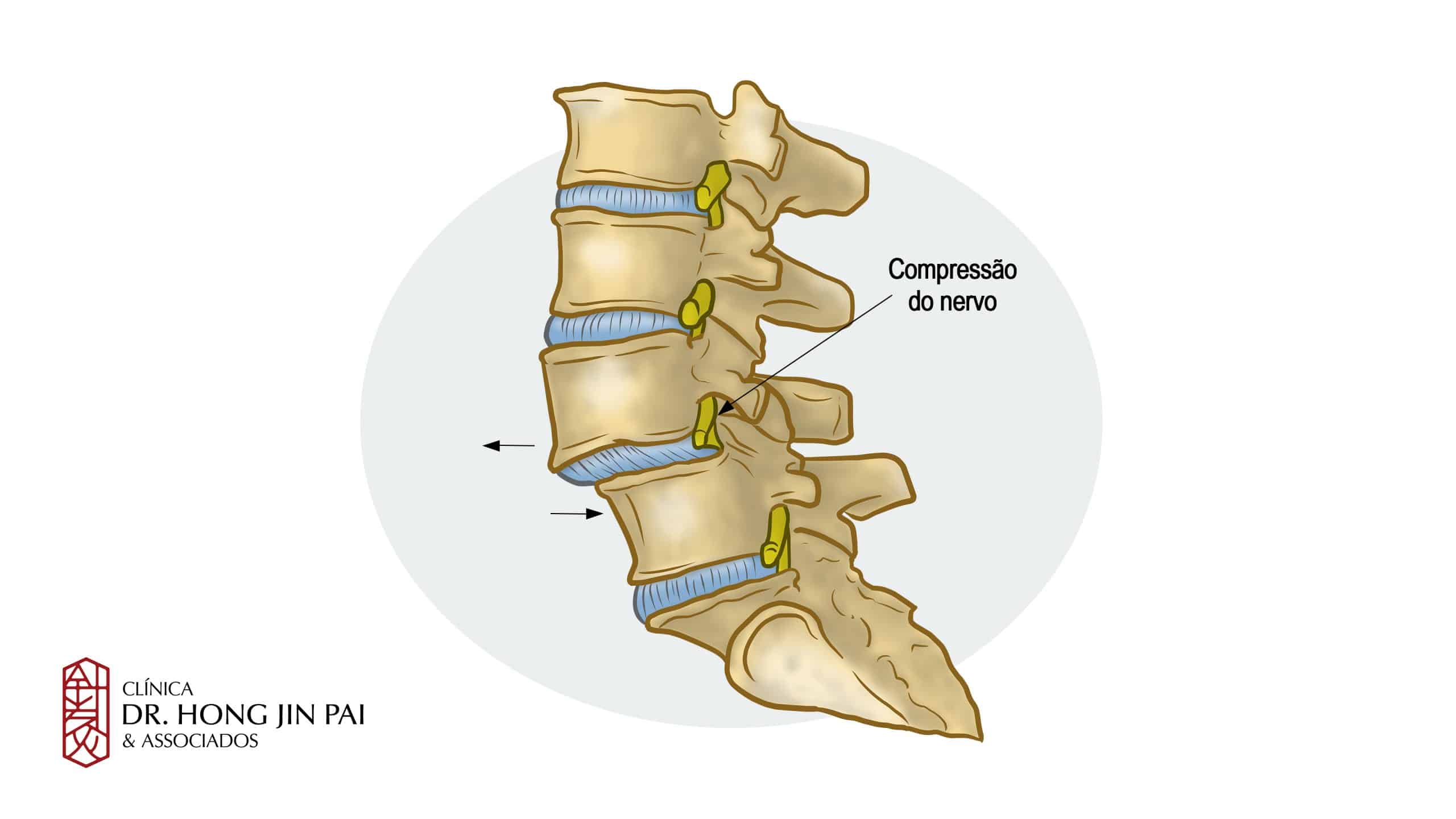 espondilolistese dano ao nervo