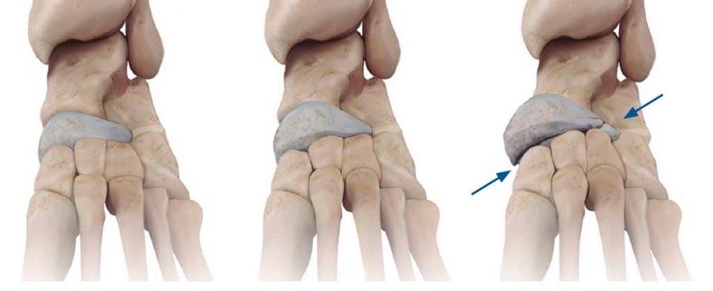 Renderização 3D dos ossos do pé em três etapas mostrando o osso navicular progressivamente achatado e colapsado, com setas azuis indicando a deformidade