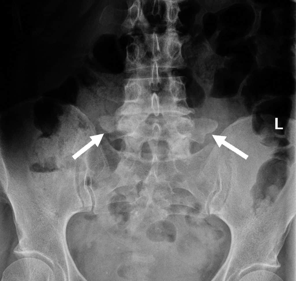 Radiografia frontal da coluna lombossacra e da bacia com duas setas brancas apontando para processos transversos alargados de uma vértebra de transição, com marcador de lateralidade L.