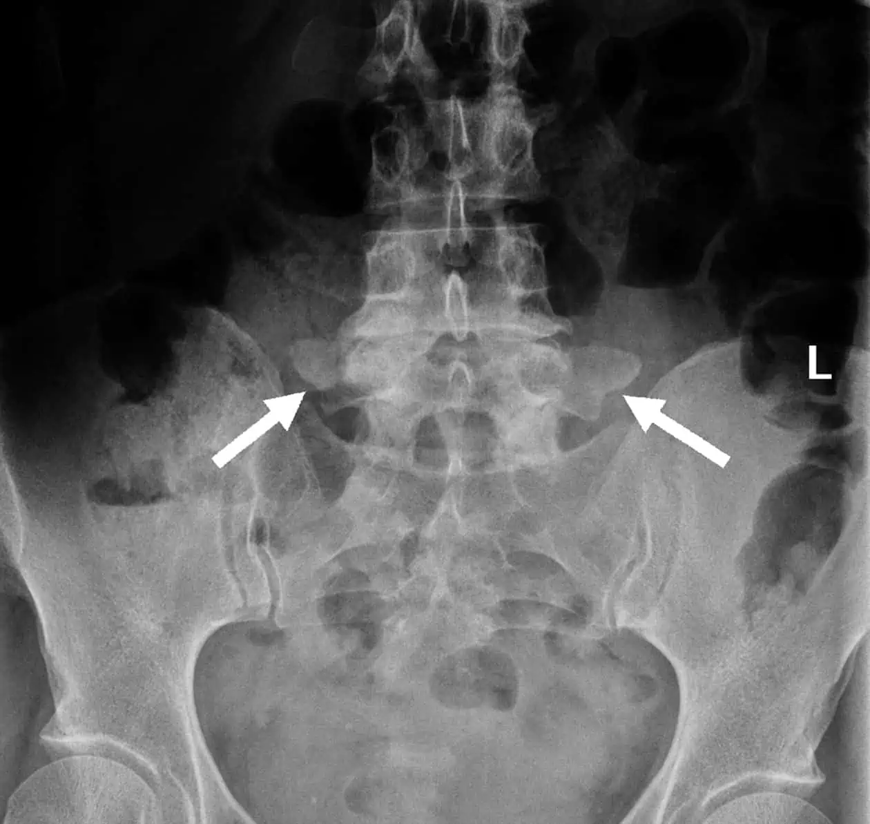 Vertebra de Transicao