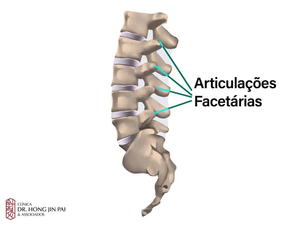 Diagrama anatômico da coluna lombar em vista lateral com as articulações facetárias destacadas e identificadas por setas verdes.