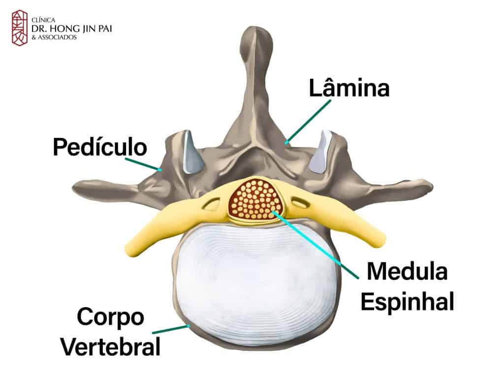 Vértebra vista de cima com corpo vertebral, pedículo, lâmina e medula espinhal identificados por setas