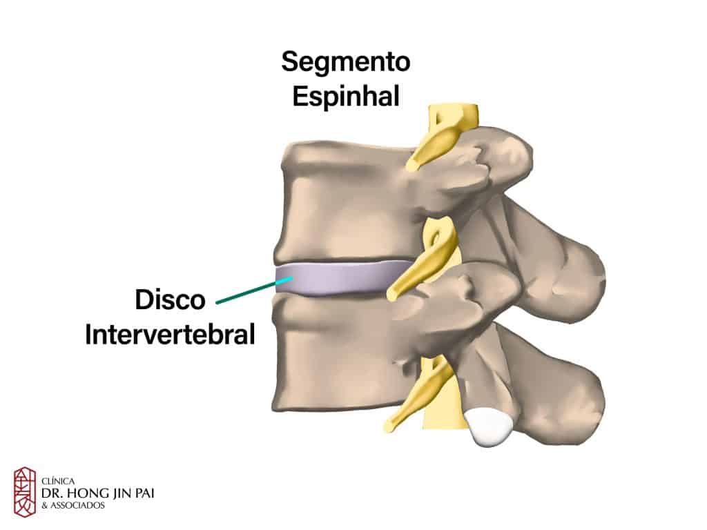 Render lateral de duas vértebras com o disco intervertebral roxo entre os corpos e a raiz nervosa saindo ao lado