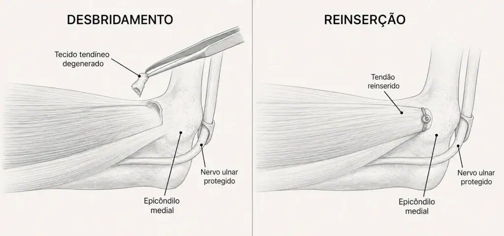 Ilustração cirúrgica em dois painéis mostrando desbridamento seletivo do tendão flexor-pronador, proteção do nervo ulnar e reinserção no epicôndilo medial.