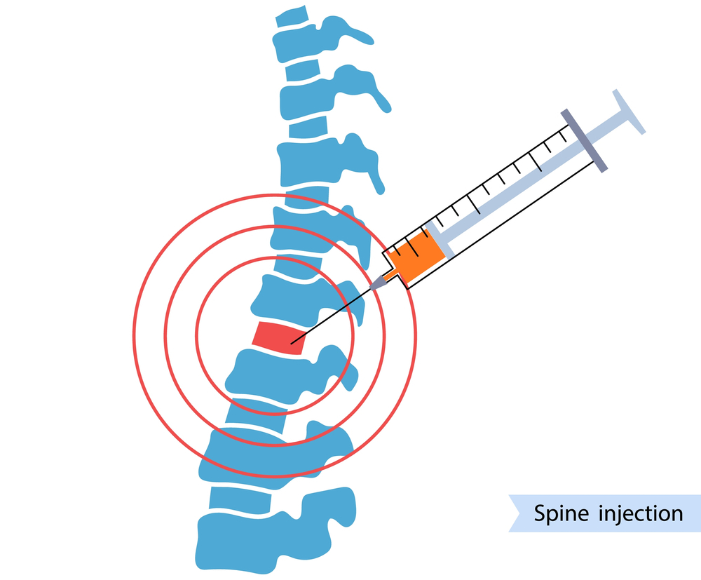 Injeção para dor na coluna: Conheça os tipos e como age cada uma