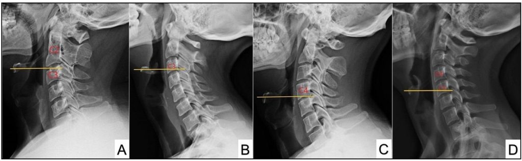 retificacao da lordose cervical