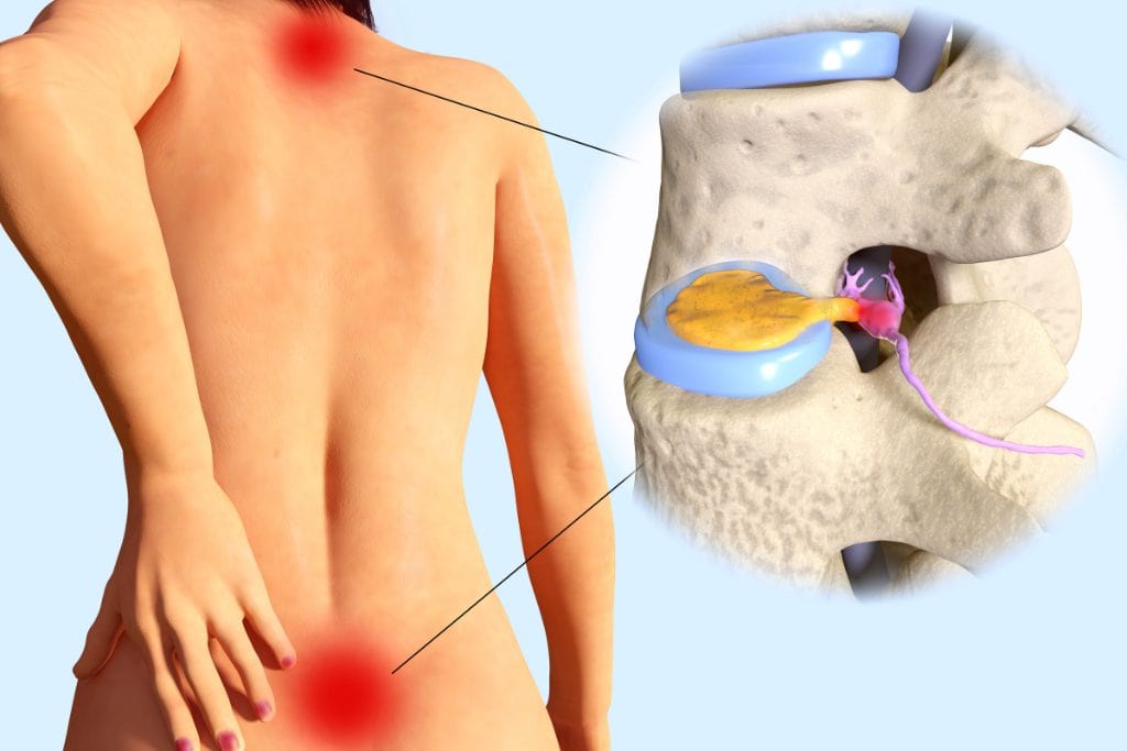 Render 3D de coluna lombar com disco intervertebral herniado em amarelo comprimindo a raiz nervosa, ao lado de uma vista das costas com pontos de dor sinalizados em vermelho.