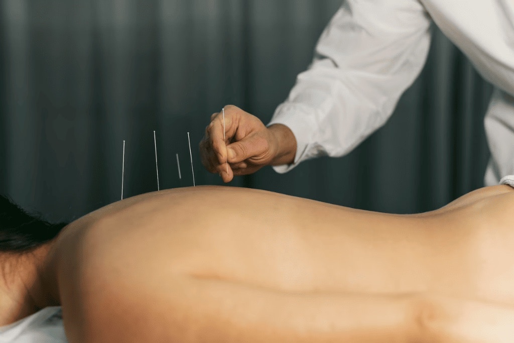 Profissional de jaleco branco insere agulhas finas de acupuntura na região lombar de um paciente deitado.