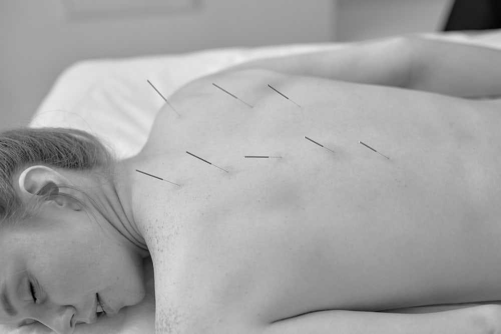 dry needling agulhamento seco