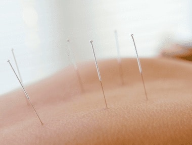 Acupuntura no tratamento da dor na coluna.
