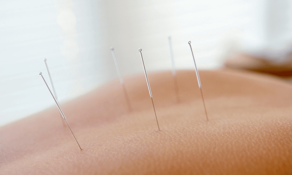 Acupuntura no tratamento da dor na coluna.