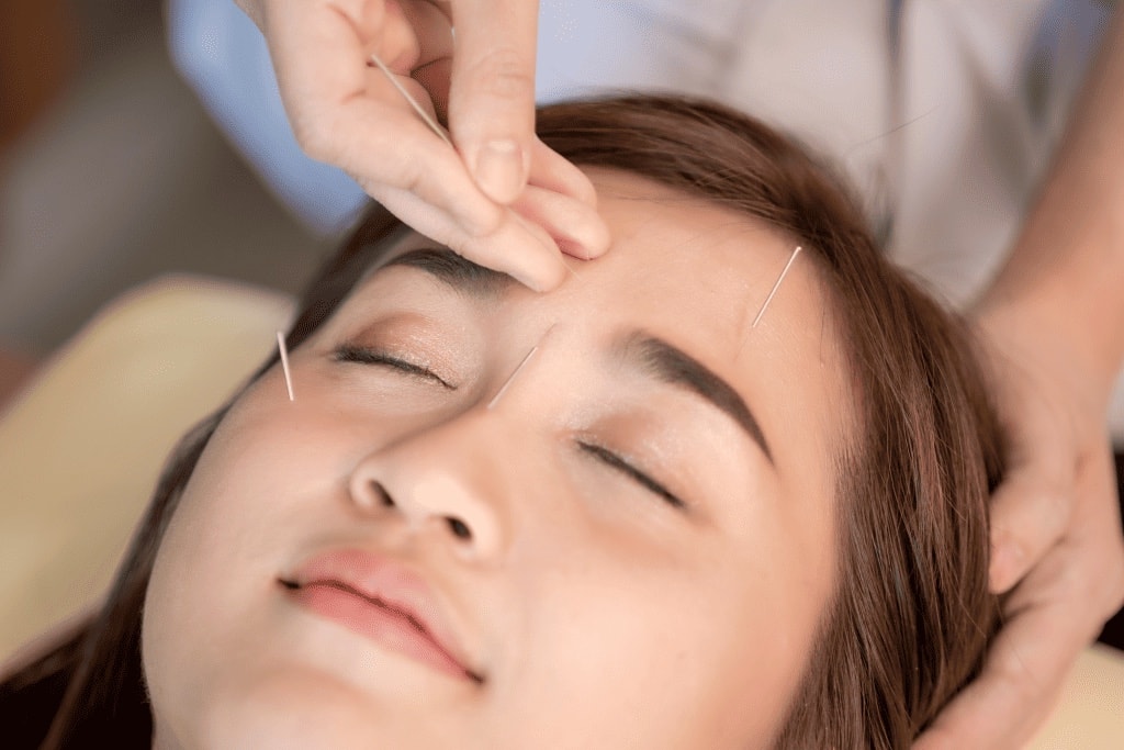 Agulhas finas de acupuntura aplicadas na testa de uma paciente de olhos fechados